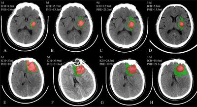 Defining Delayed <mark class="highlighted">Perihematomal Edema</mark> Expansion in Intracerebral Hemorrhage: Segmentation, Time Course, Risk Factors and Clinical Outcome